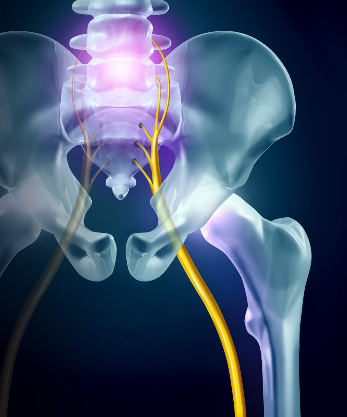 Sciatica Pain After a Car Accident — Maryland Accident Lawyer Blog